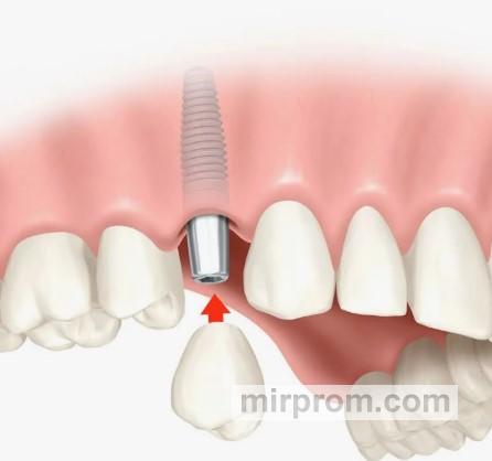Имплантация зубов в Оренбурге