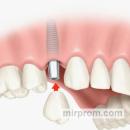 Имплантация зубов в Оренбурге